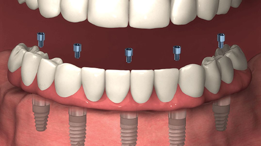 ⁣Rielo Dental Clinic : #1 Dental Implants in Hialeah, FL | 305-231-5455