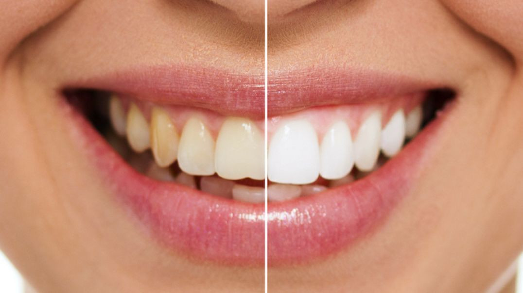 Veneto Dental Care : Teeth Whitening in Miramar, FL | (954) 430-7789
