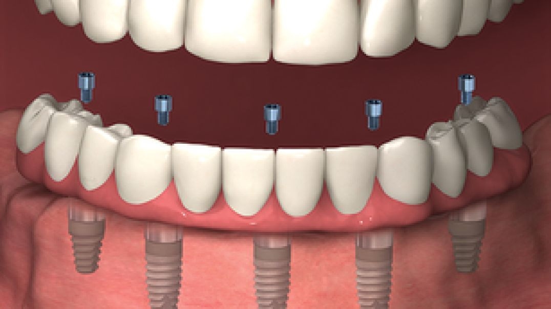 ⁣Apple Dental Group : Dental Implants in Doral | 33166
