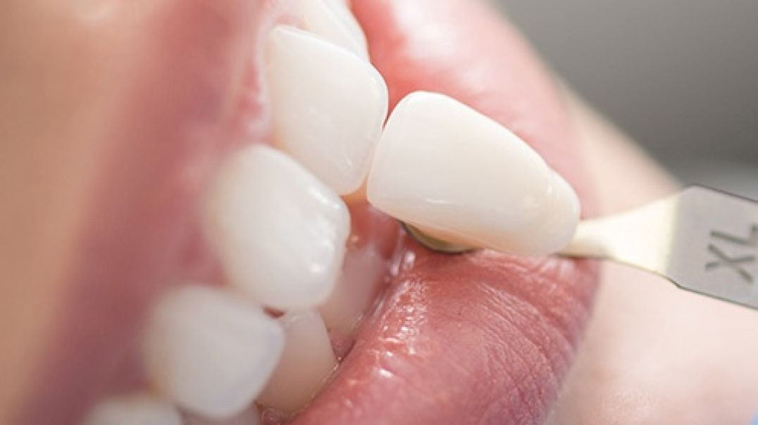 ⁣Comfy Smile Dental : Best Veneers in Davie, FL